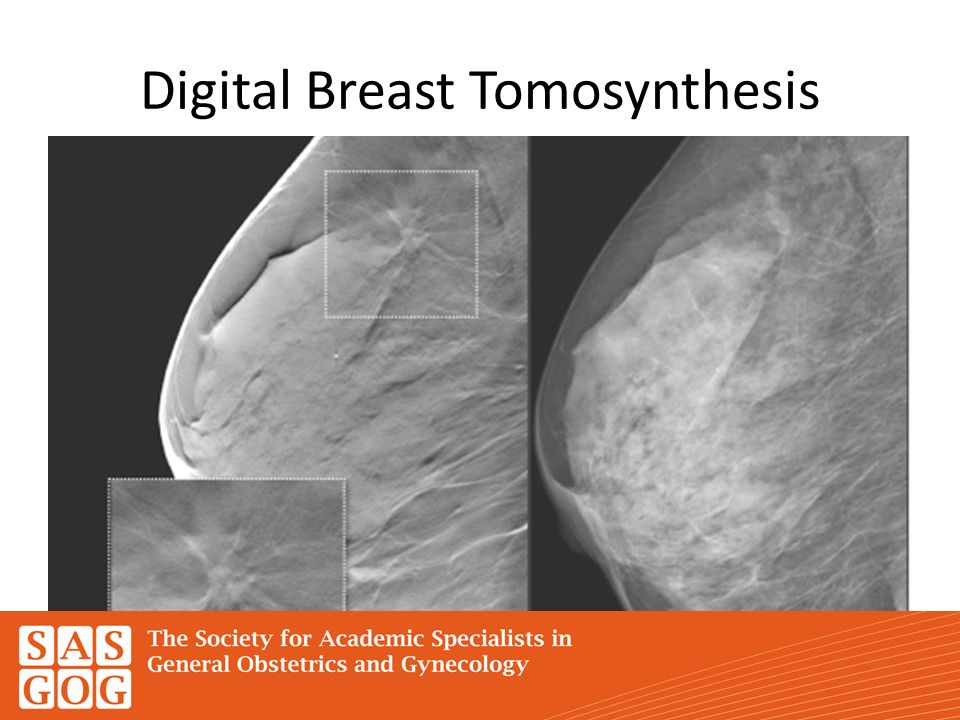 Breast Biopsy Procedures